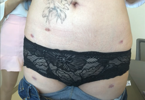 thigh-liposuction-scars